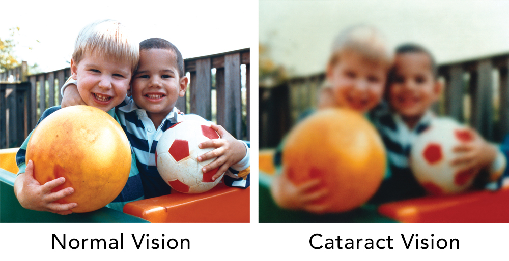 cataract vision